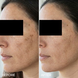 Sérum Facial Liposomal Azelac Ru para el tratamiento de manchas, marcas y opacidad - Sesderma