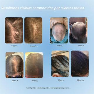 Growplex Vitafoam Espuma de minoxidil al 5% - Growplex