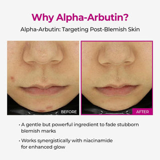 Serum facial Cemenrete Picotonic Shot: corrector de pigmentación con alfa-arbutina y niacinamida - Dr. Melaxin