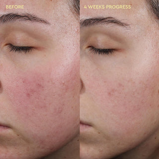 Crema facial Blemish Acne Control Moisturizer - BYOMA