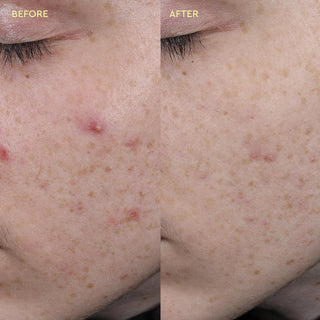 Blemish Acne Treatment Spot Paste con Cica + Salicylic Acid - BYOMA
