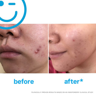 Limpiador facial diario EradiKate™ 3% Sulfur + Acne Treatment - Kate Somerville