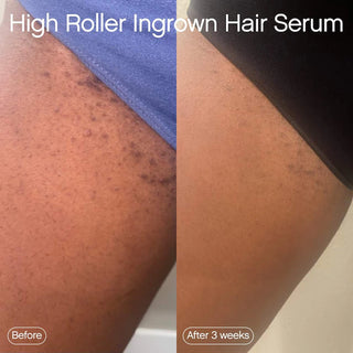 High Roller Ingrown Hair Tonic with AHA and BHA - Topicals