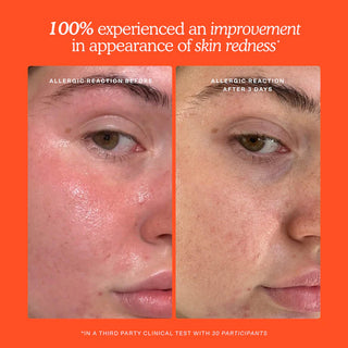 Bruma facial SOS Daily Hypochlorous Acid Spray for Breakouts & Redness - Tower 28 ⚡