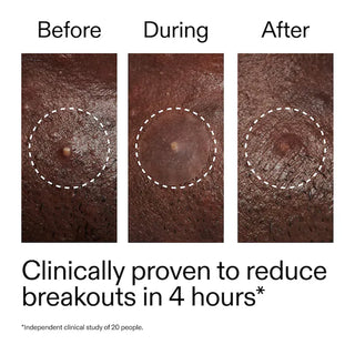Parches para acné Hydrocolloid Invisible Pimple Patches + Salicylic Acid - The INKEY List