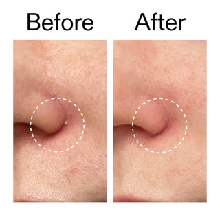 Parches para acné Hydrocolloid Invisible Pimple Patches + Salicylic Acid - The INKEY List